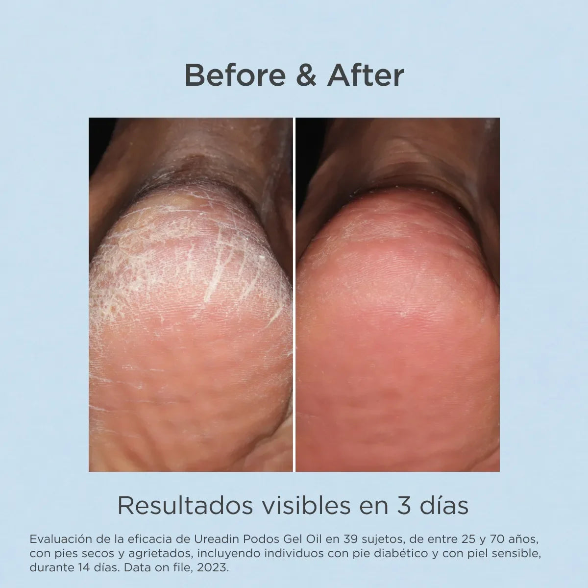 Ureadin® Podos Gel Oil